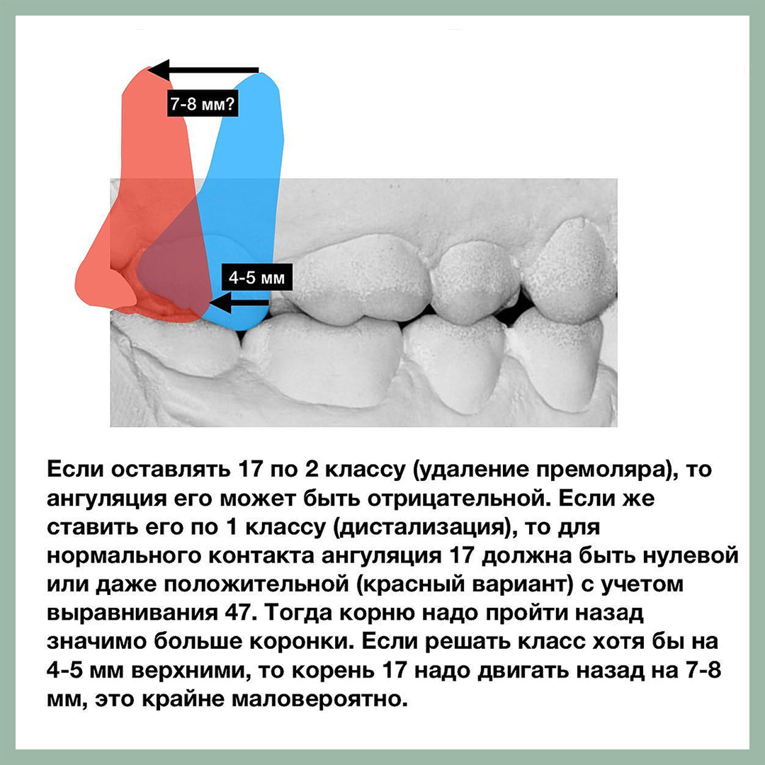 Дистализация или удаление? - интересно об ортодонтии, имплантации и  протезировании зубов